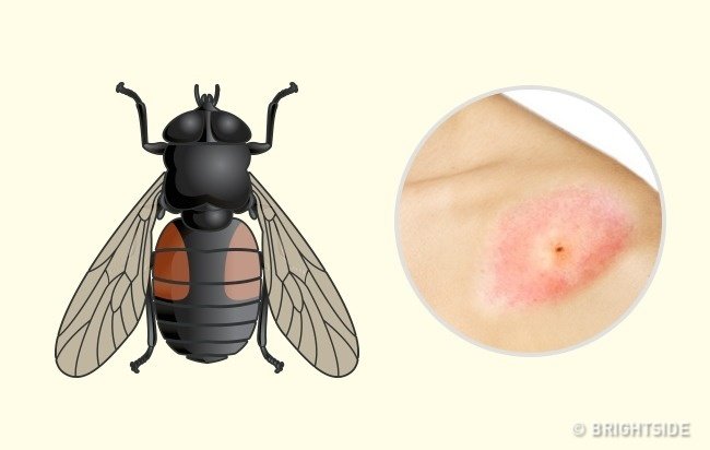 Simple way to 'identify' insect bites Picture 8