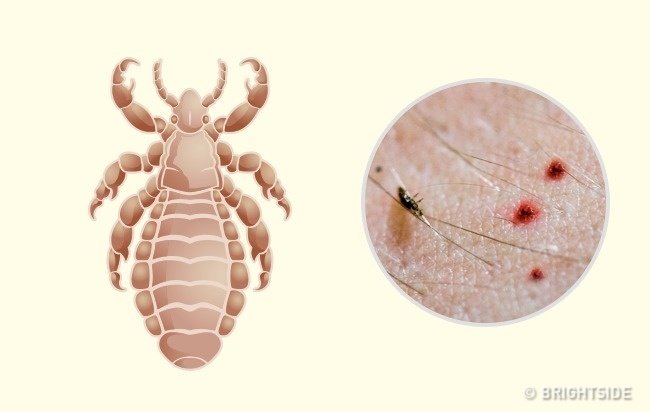 Simple way to 'identify' insect bites Picture 9