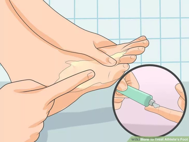 Solution for treating athlete's foot Picture 10