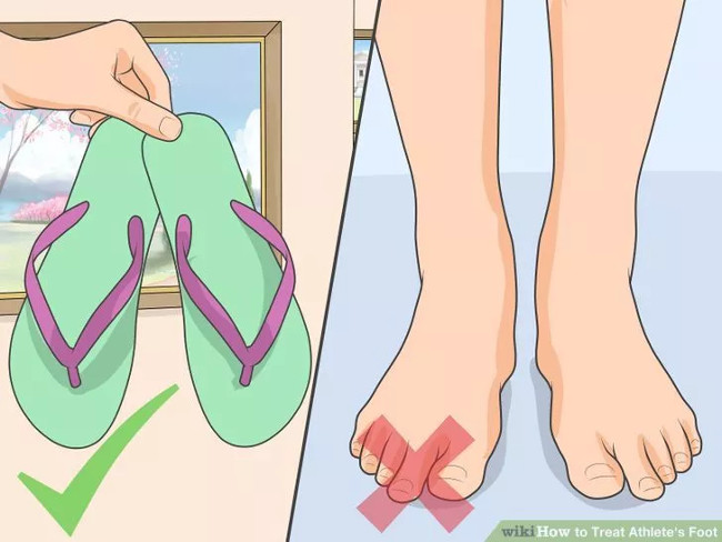 Solution for treating athlete's foot Picture 15