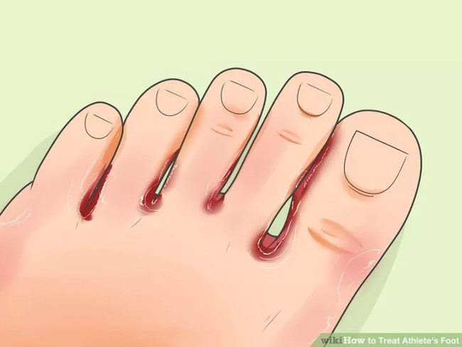 Solution for treating athlete's foot Picture 4