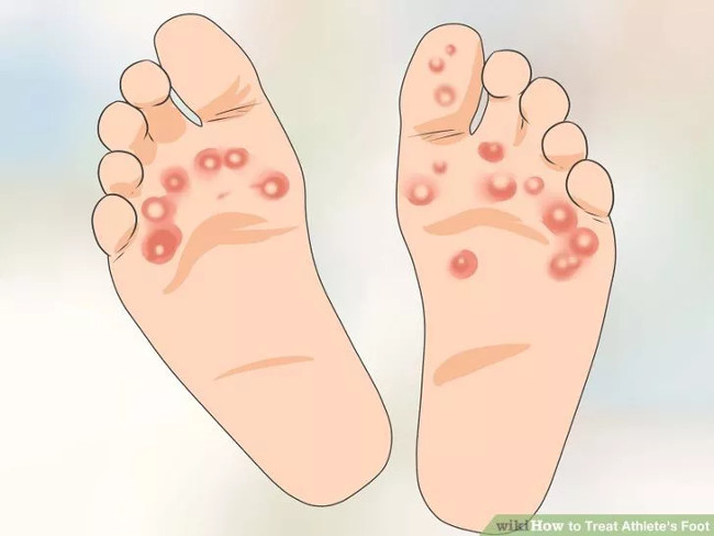 Solution for treating athlete's foot Picture 6