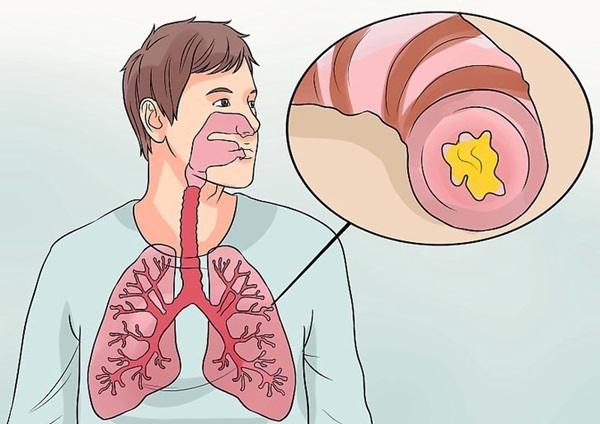 Sputum much good? Instructions on how to expel sputum effectively Picture 2