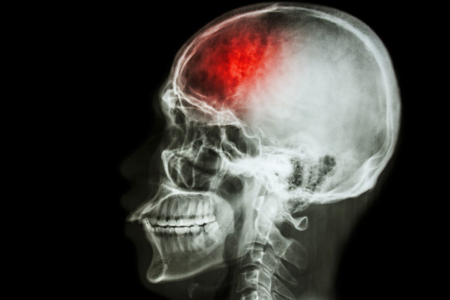 Stem cells help patch brain damage in stroke victims Picture 1