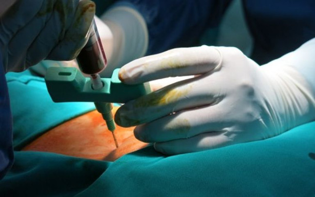 Strangely, people with 45% burns are healed quickly with stem cell therapy Picture 3