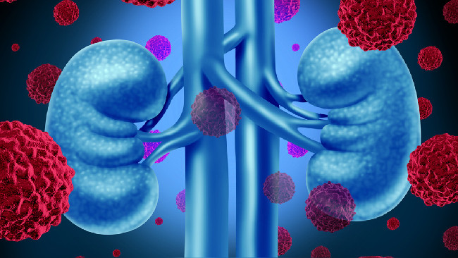 Surgery may double the life expectancy for patients with kidney cancer Picture 1