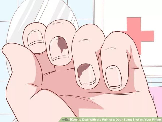 The first aid steps in time when the hand jammed into the door gap Picture 10