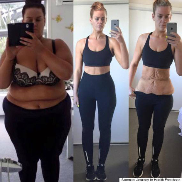 The terrible consequences of your body suddenly lose weight Picture 2