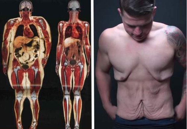 The terrible consequences of your body suddenly lose weight Picture 4