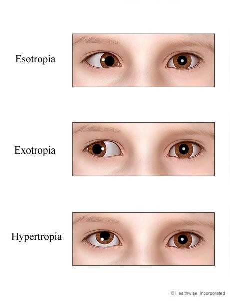 Things to know about amblyopia (amblyopia) Picture 2