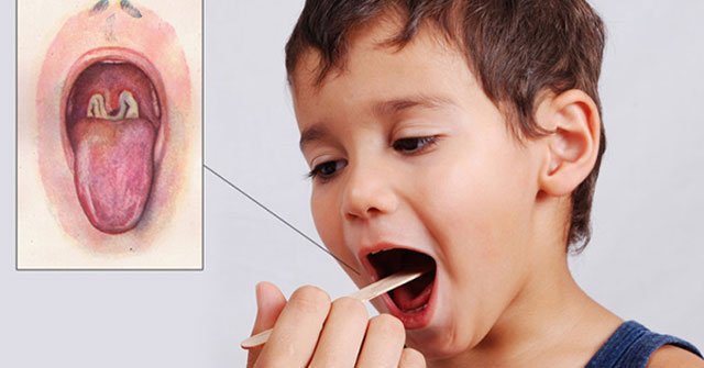 Things to know about diphtheria Picture 2