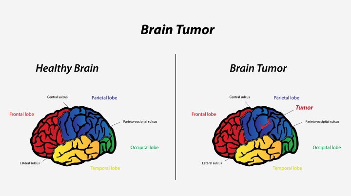 Things you need to know about brain cancer Picture 3