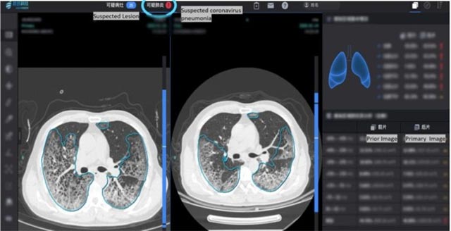 This AI 'doctor' is being used to quickly diagnose Corona virus Picture 1