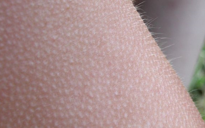 This is the only part of the body that never 'goosebumps'.