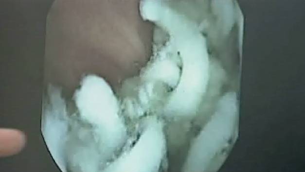 This is what happens in the stomach when you eat shrimp noodles Picture 4