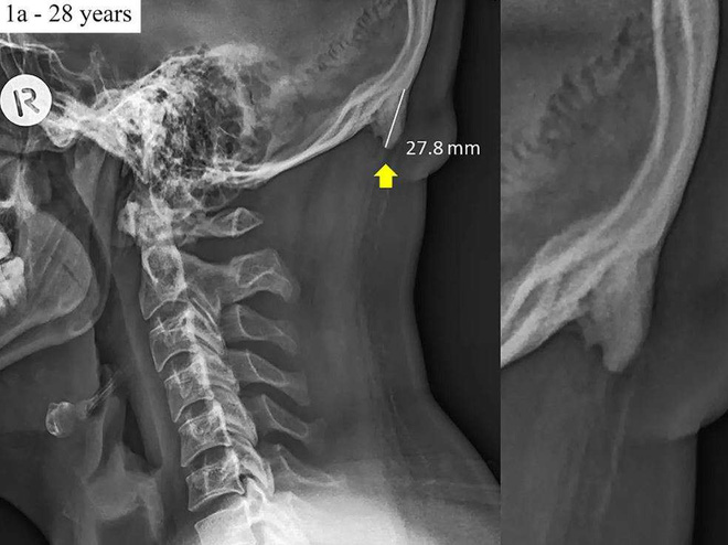 Using the wrong smartphone can cause your skull to 'tail' Picture 1