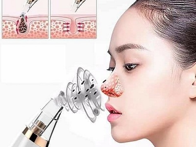 Vacuum blackheads, bran acne good? Which kind is good? Picture 3