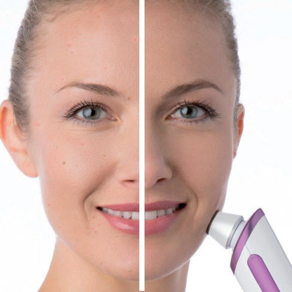 Vacuum blackheads, bran acne good? Which kind is good? Picture 7