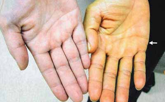 Want to prevent liver cancer, just do 3 things well Picture 4