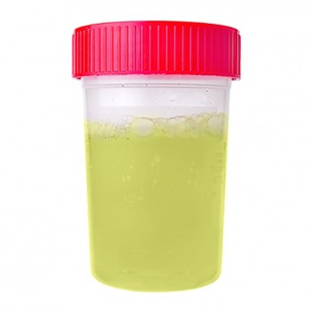 What color does urine signal about your health? Picture 5