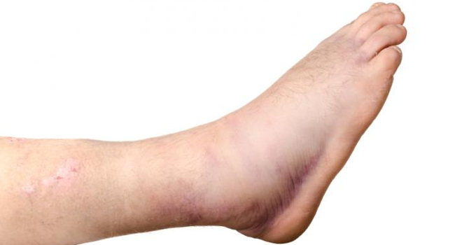 What does the foot reveal about your health? Picture 4