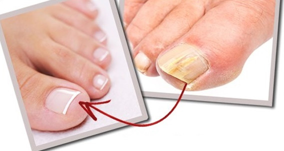 What does the foot reveal about your health? Picture 6