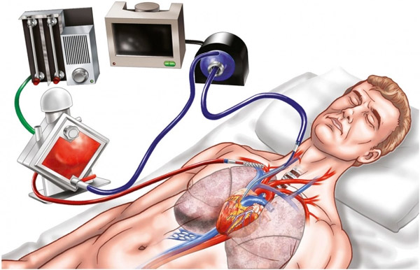 What is ECMO? In which case does the patient need ECMO intervention? Picture 1