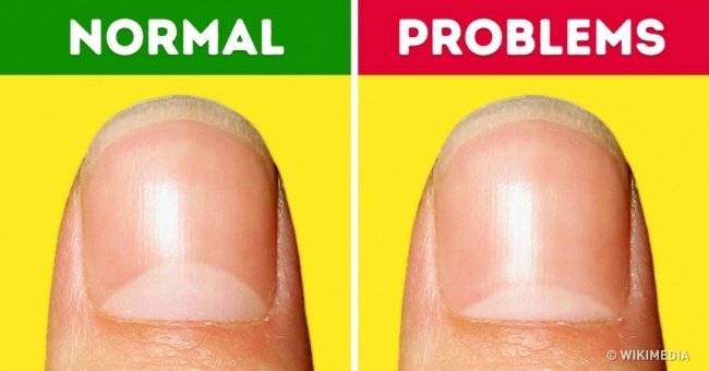 13 Health Problems That Crescent-shaped on Nails Are Trying to Warn