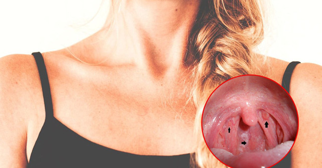 5 Habits Unknowingly Cause Throat Cancer to Visit You Soon