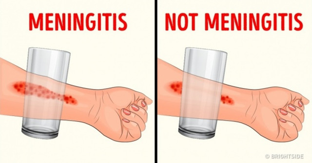 8 Signs of Childhood Meningitis That Parents Should Pay Attention To