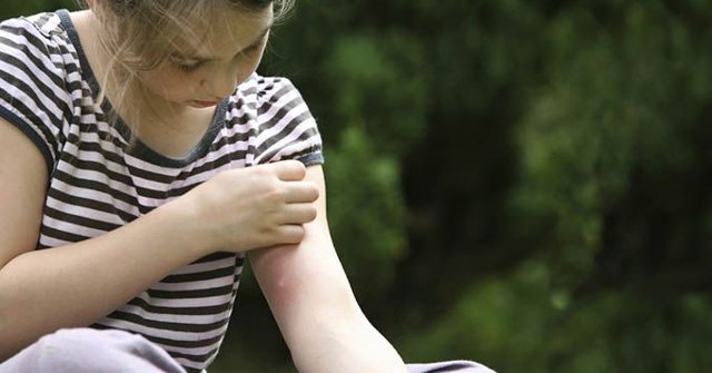 9 Reasons Why You Get Mosquito Bites More Than Others