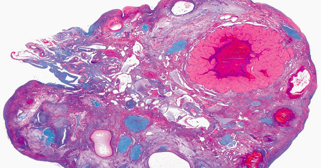 Artificial Ovaries Can Treat Menopausal Symptoms Better