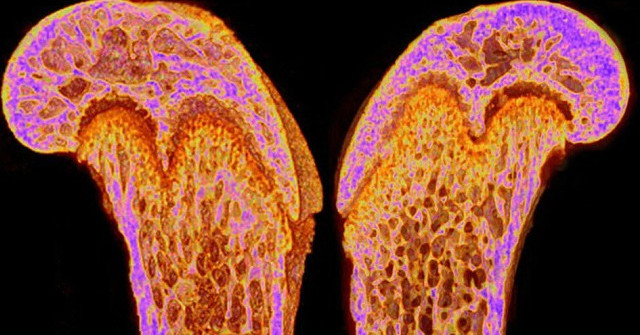 Bone-derived Hormones Reverse Memory Loss in Mice