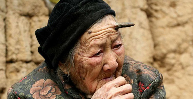 Cases of Superfluous Body Parts in the World: People with 2 Hearts