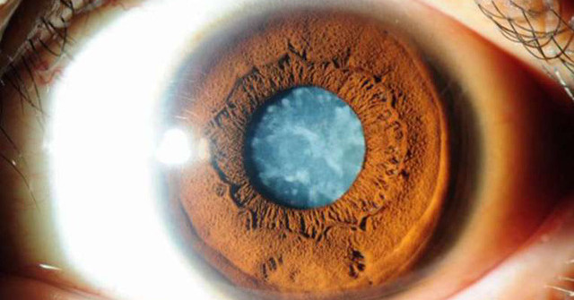 Cataract Surgery Reduces the Risk of Death in Older Women
