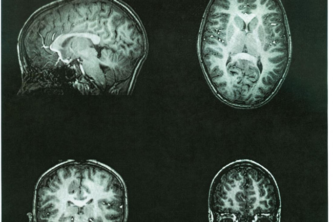 Children Who Survive a Brain Tumor Have a Very High Body Fat Content