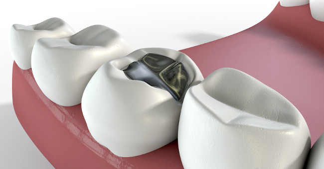 Close-up of the Extreme Deep Dental Welding Process
