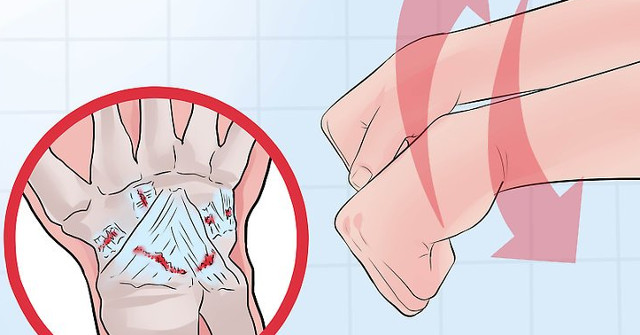 Distinguish Between Wrist Sprains and Wrist Fractures
