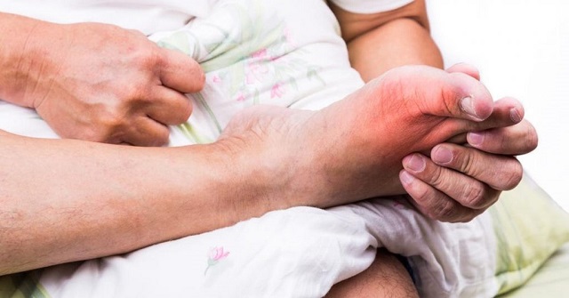 Distinguish from Acute, Chronic Gout and Gout Disease