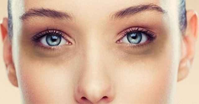 Eyes Dark Circles Is a Manifestation of What Disease? Treatment