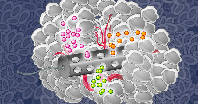 Fever with a Implant Device Creates a False Scene to Catch Breast Cancer Cells