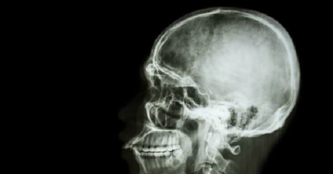 Finding a New Substance Capable of Skull Regeneration
