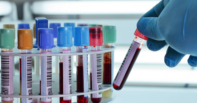 Finding Blood in the Urine May Be an Early Sign of Prostate Cancer