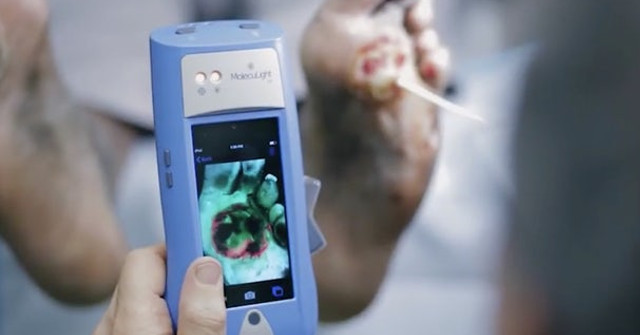 Handheld Devices Help See Bacteria on the Wound