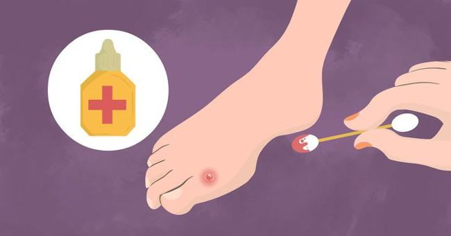 How to Treat Blisters When Walking a Lot, Wearing Tight Shoes