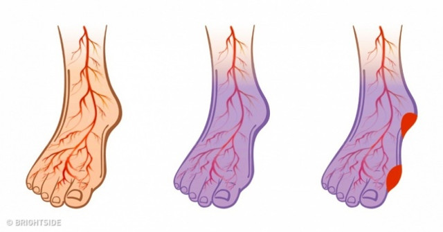 If You Have High Blood Pressure, Stroke or Varicose Veins, Apply