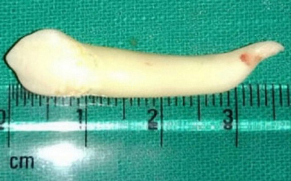 World Record: Indian Dentist Pulled Out a Record-breaking Tooth