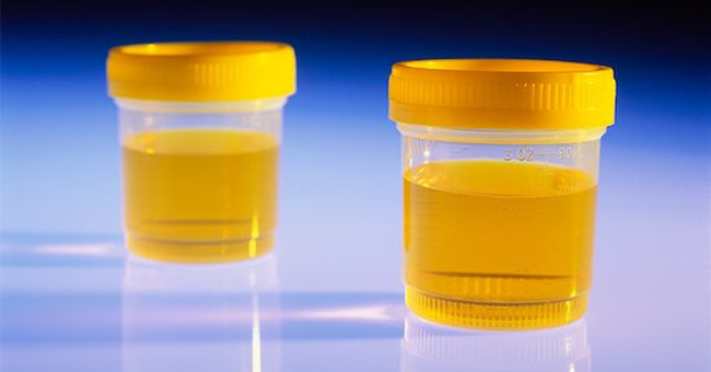 It turns out that urine tests can help diagnose neonatal respiratory ...