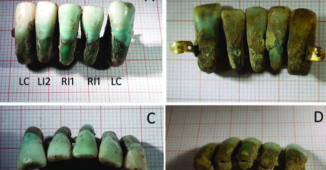 Italian Archeology Finds the Oldest Set of Dentures in the World