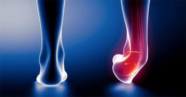 Long-lasting Sprains Can Cause Chronic Illness